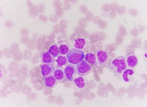 Some facts about Leukemia